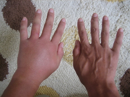 アシナガバチに刺されて腫れが引き始めた農業機械のブログ