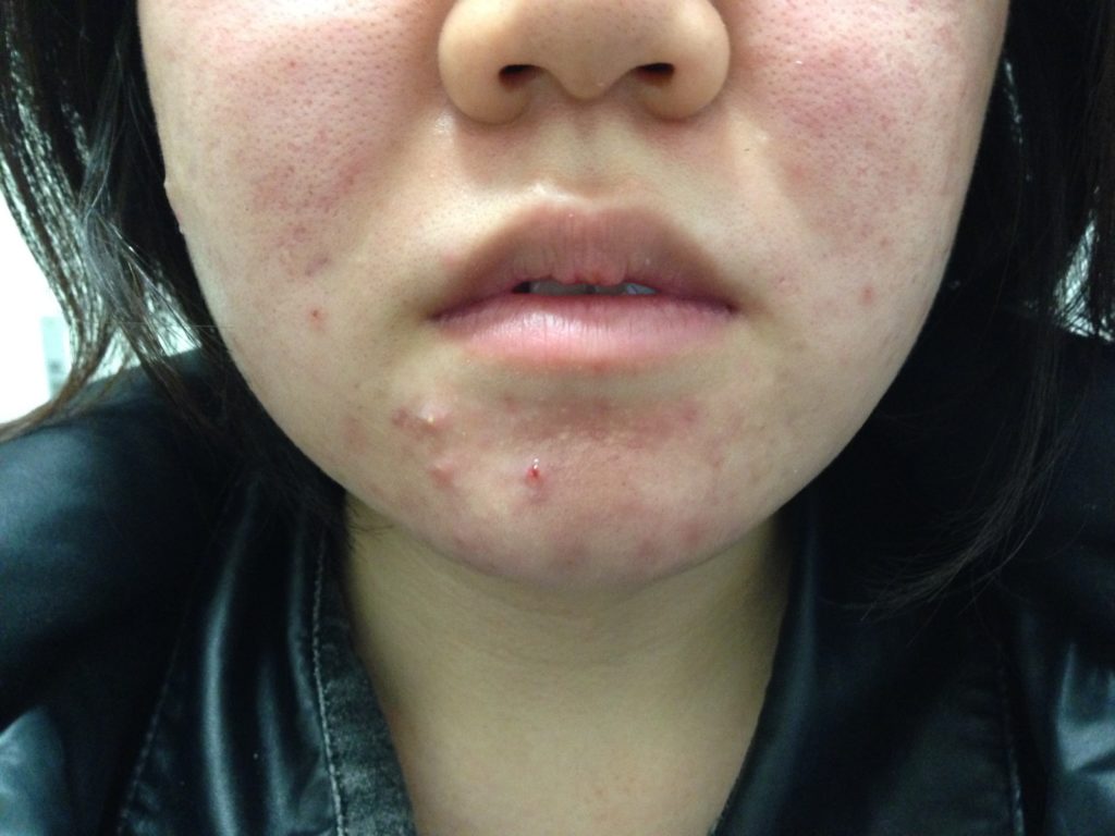 ニキビは即効で治せる？繰り返しできる大人ニキビ・思春期ニキビの治し方についても解説