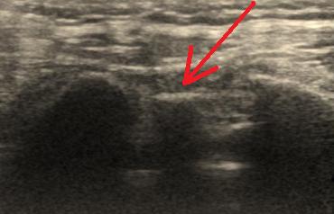 4 Os sacrumsacraleVertebrae sacrales I－V仙骨 仙椎SacrumVertebraesacrales 1－5