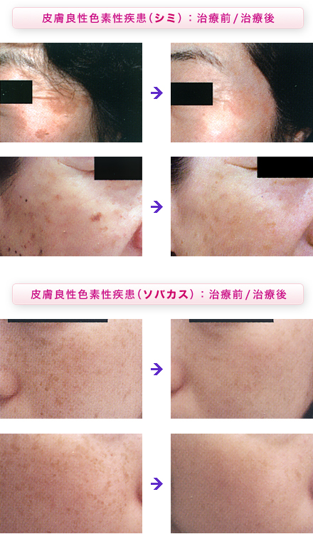 シミレーザー治療経過と処置 - 東京・大阪の美容皮膚科ならFLALU フラルクリニック