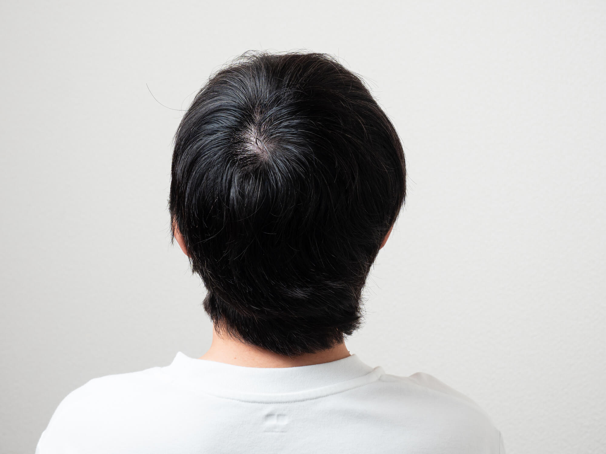 若ハゲ 高校生でも禿げますか？発毛のプロが徹底解説 - YouTube