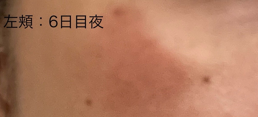 ひまし油と重曹で顔のシミを取る実験 カソーダ- YouTube