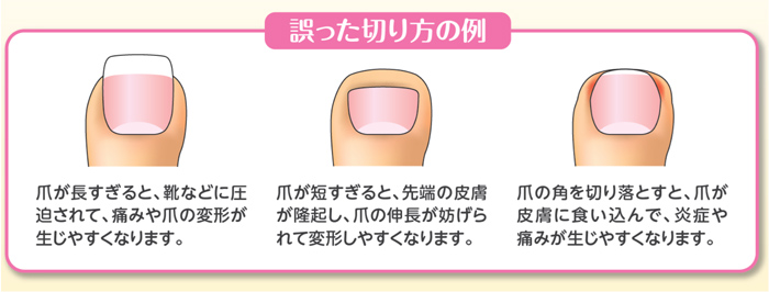 陥入爪 - 大阪医科薬科大学形成外科
