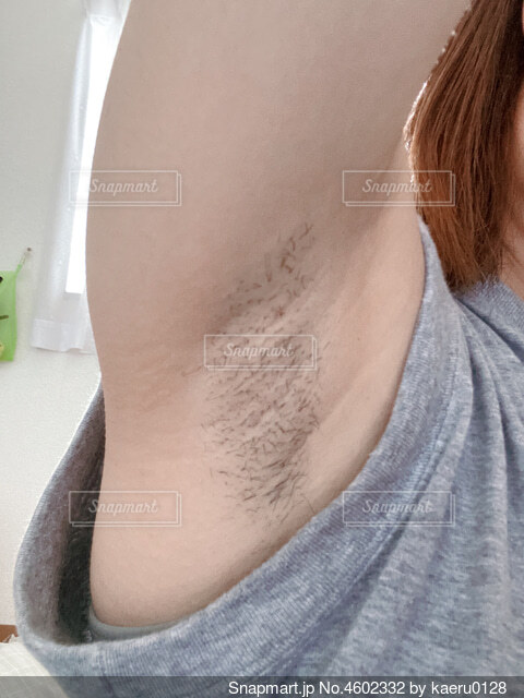 女性の医療脱毛 脇毛の永久脱毛を希望され来院 症例写真- ヘアケアクリニック 六本木・福岡のAGA治療・注入療法