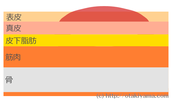 褥瘡予防のためのポジショニング：座位90度ルール