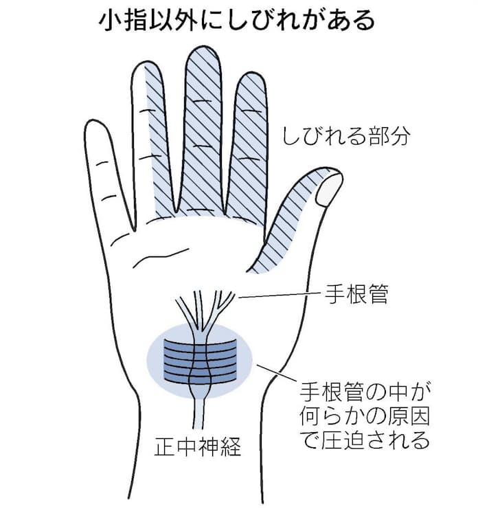 手のしびれ その症状と原因ヘルスきゅんと:宮日生活情報紙