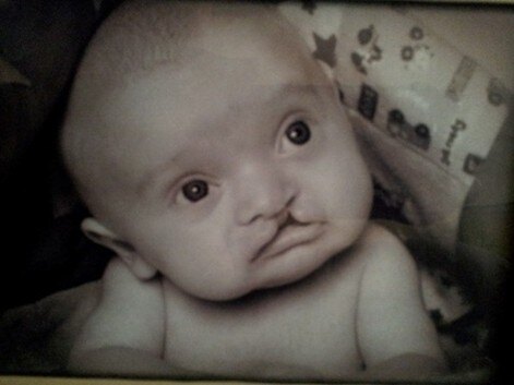 口唇口蓋裂 哺乳瓶の工夫 手術 術後の経過など 「娘が頼もしい。この子らしい人生に寄り添いたい」