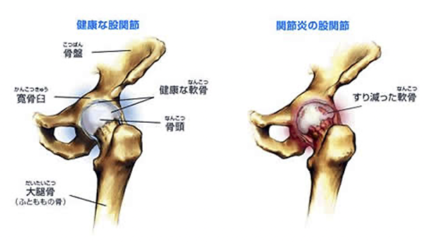No.015 太もも外側 内側の施術内容症例写真脂肪吸引ならクリニック日比谷