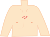 ニキビ跡の盛り上がり治療ケロイド・肥厚性瘢痕肌のクリニック東京