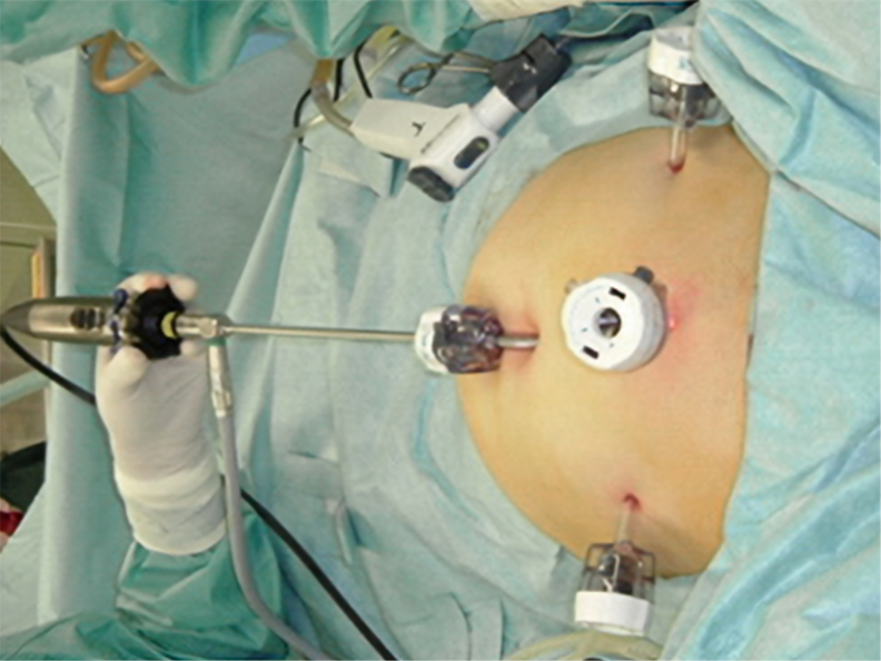 術後の経過：6週間後子宮筋腫を摘出したよ！改、外資系社員がPh+ALL急性リンパ性白血病に