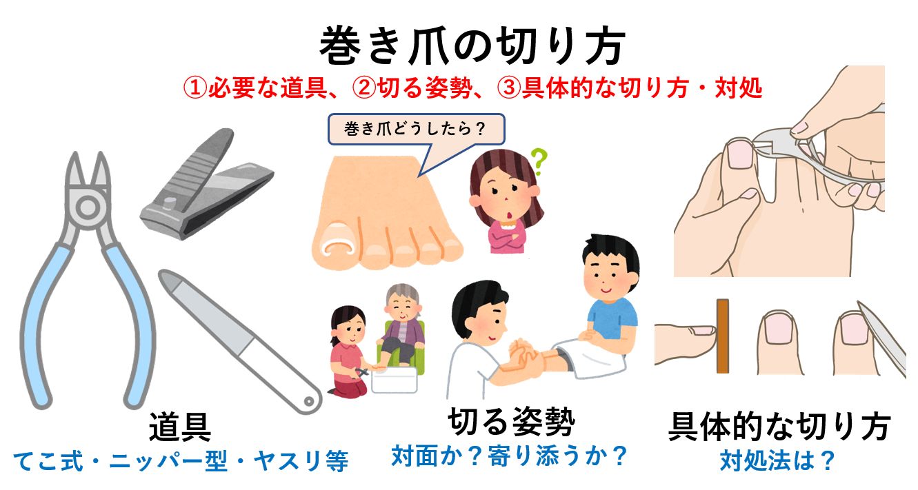 巻き爪の原因と防止法 正しい爪の切り方 巻き爪 大阪 の巻き爪ドットコム