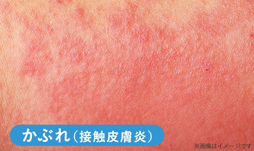 おしりのブツブツが気になる！ちゃんと洗っているのにできてしまう理由とは