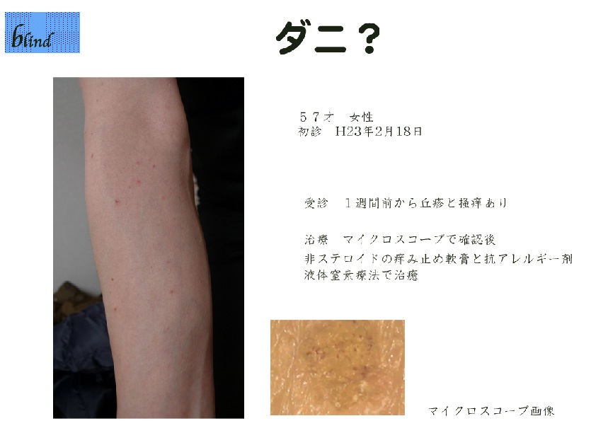 トコジラミの噛み跡の特徴は？画像や見分け方を紹介！ダニやシラミとの違いは？害獣駆除業社おすすめ徹底比較