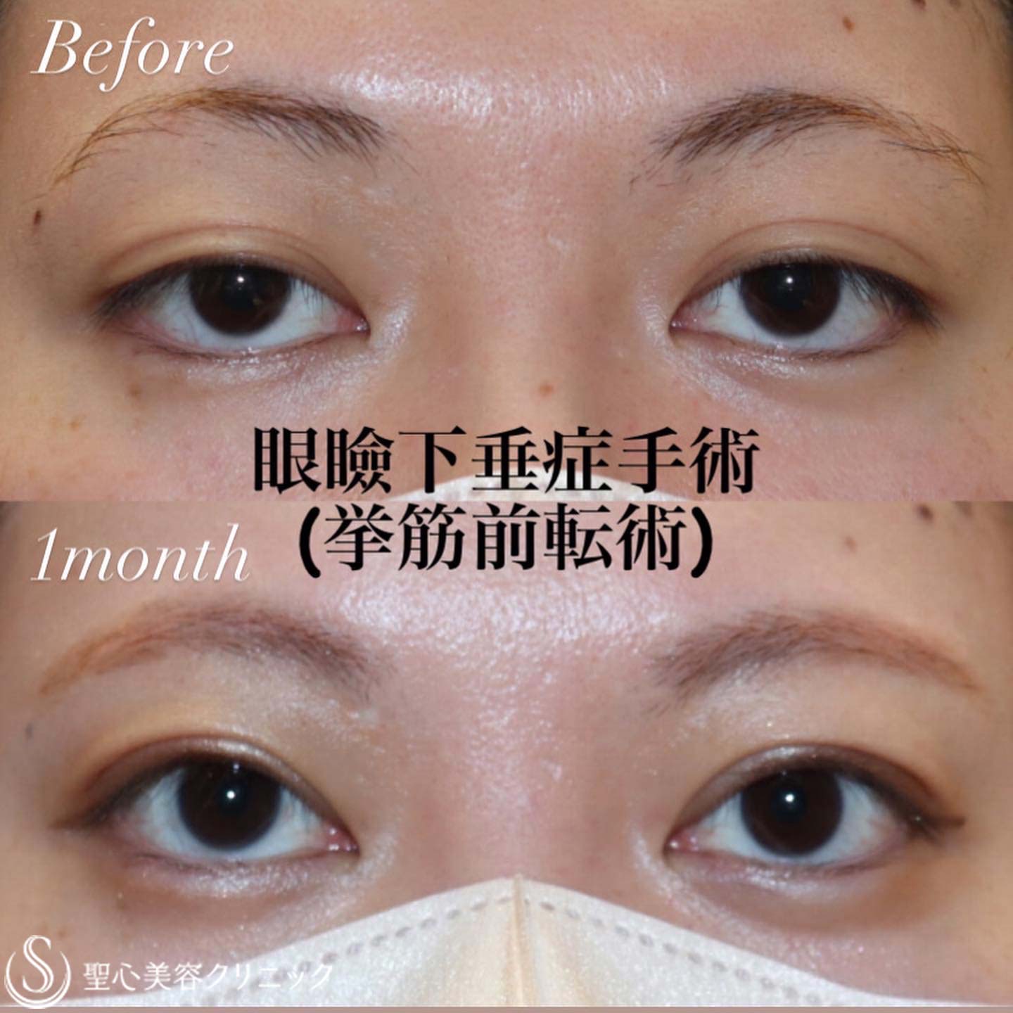 眼瞼下垂手術なら眼瞼下垂治療の名医が担当する自由が丘クリニック