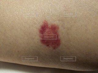 マダニ刺症① 四街道でもマダニに刺されます！松島皮膚科医院千葉 四街道の皮膚科・美容皮膚科の専門医