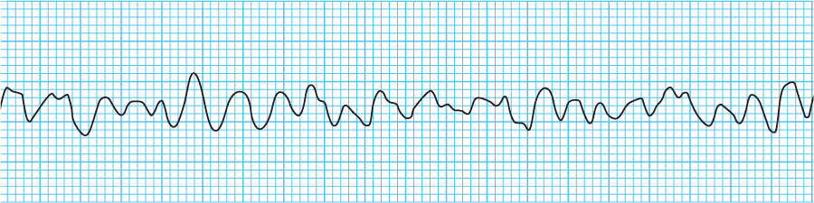 ステップアップで理解する心電図講座 Web解説