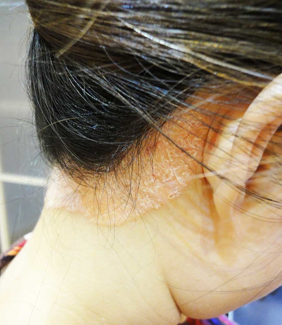 乾癬表現很多樣，正確診斷很重要 照護線上-深受信賴的醫療媒體