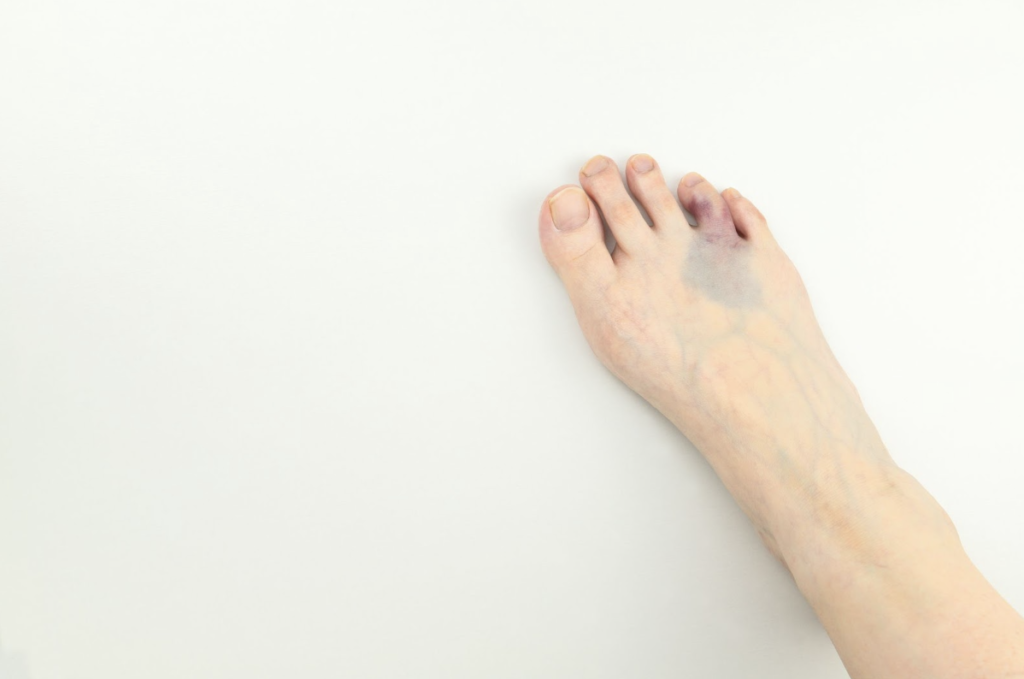 血液専門医が解説 青あざが出来やすいハレノテラス すこやか内科クリニック見沼区・東大宮