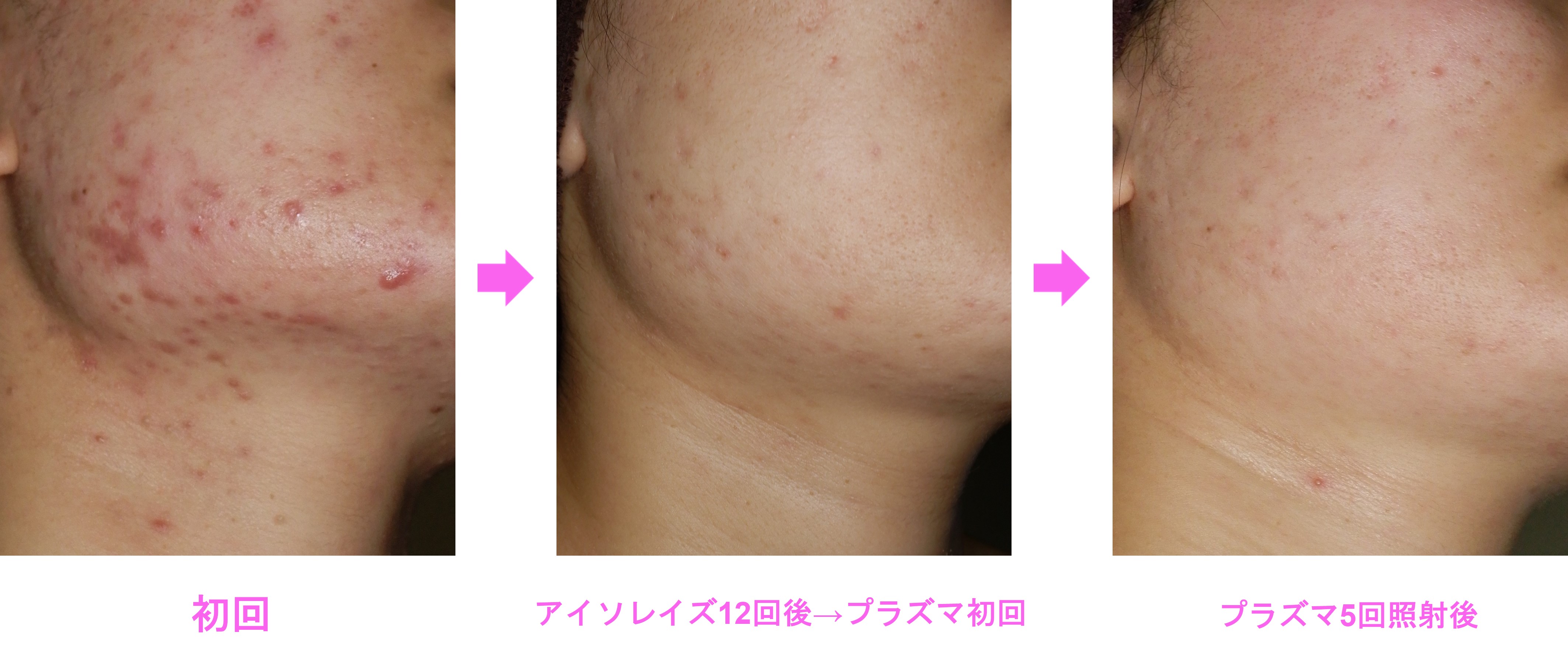 b.glen ニキビ跡ケア・毛穴ケア・ホワイトケア