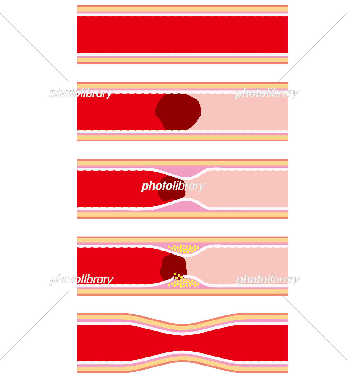 728 動脈硬化 High Res Illustrations - Getty Images血管, 頸動脈, 医療