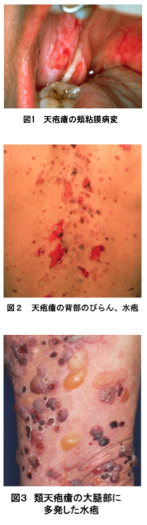 自己免疫性水疱症と口腔内びらん - みやけ内科・循環器科 総合内科のアプローチ