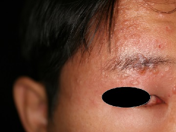 帯状疱疹写真で見る「子どもの病気」 - みやけ内科・循環器科 総合内科のアプローチ