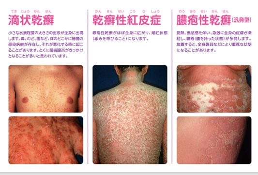 膿疱性乾癬日本医科大学武蔵小杉病院