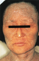 アミロイド苔癬の治し方川崎市多摩区のアトピー専門整体「英気治療院」