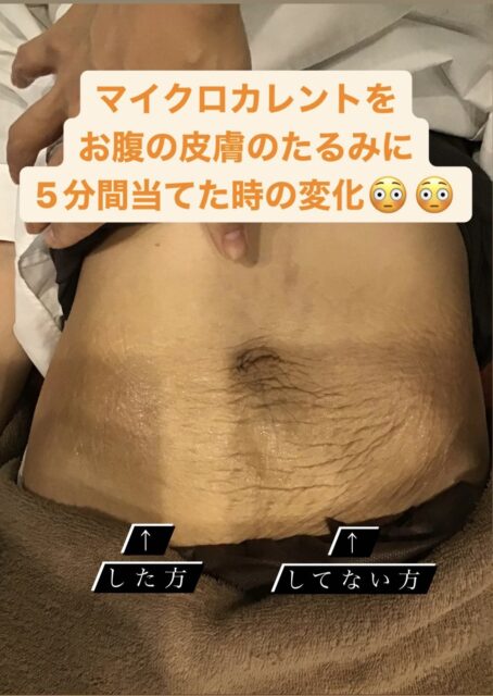 産後の下腹のたるみ解消法2025 年のリアルなLemon8ユーザー体験