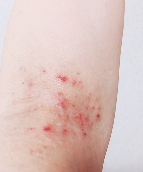 単純性顔面粃糠疹 -子供の顔に白いはたけ 畑ではありません ができています-大和クリニック-木更津市の皮膚科