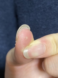 指の腱鞘炎スポーツ障害に強い 関節の痛みの専門家 しまもと整体院