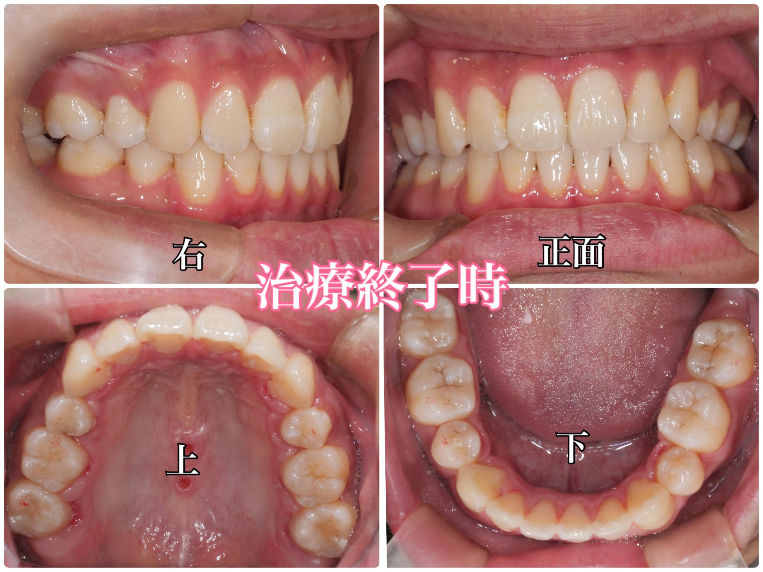 矯正経過報告ー2.5ヶ月ー - 33歳からの歯列矯正日記