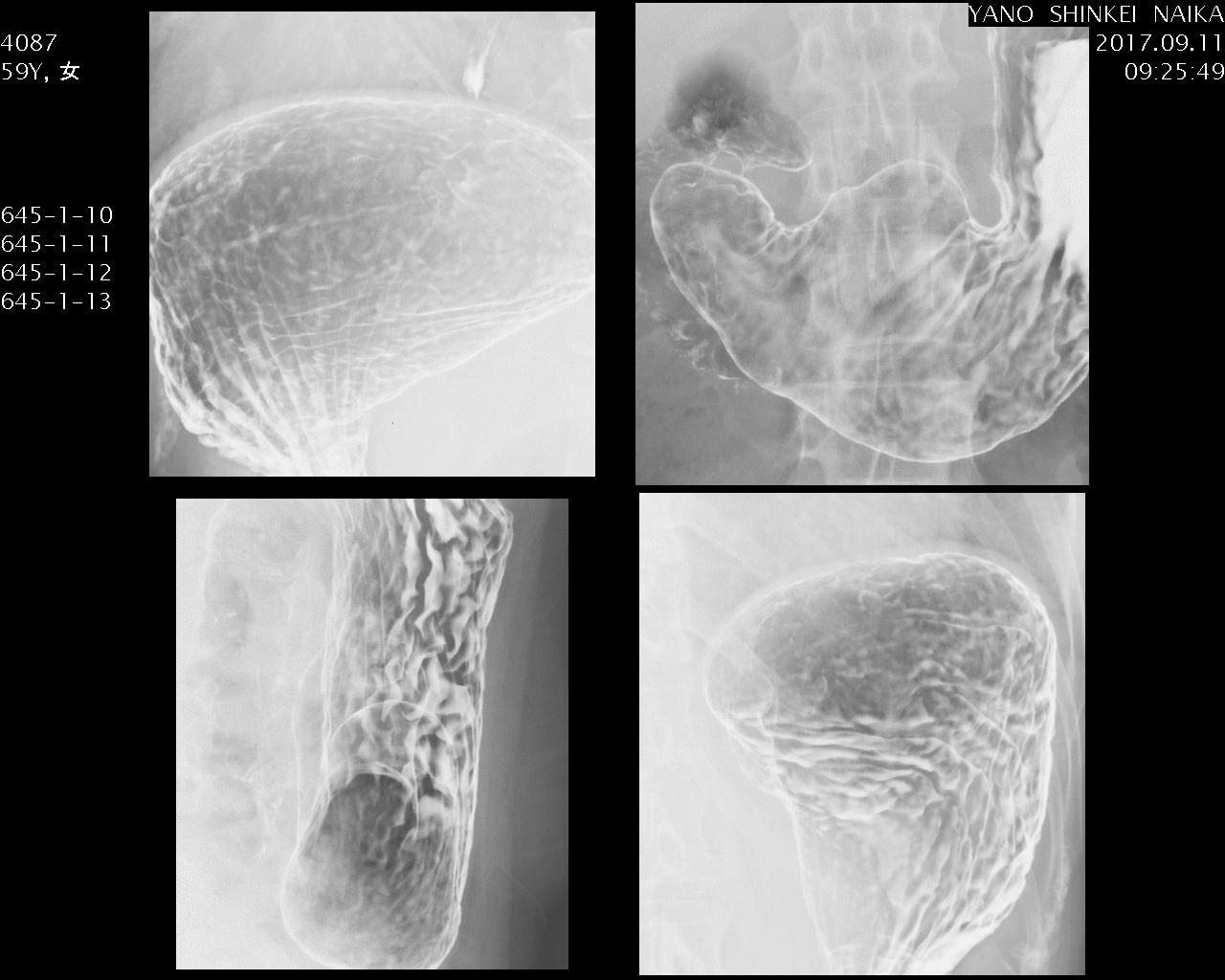 胃X線検査の撮影方法・画像の見方 - 第1種放射線取扱主任者試験対策