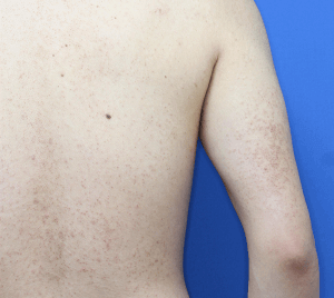 二の腕ブツブツの原因と治し方！尿素はダメ！薬用クリームランキング