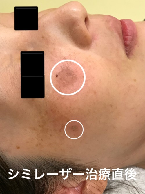 しみ治療後の経過・アフターケアについて - 銀座お肌の診療所 公式