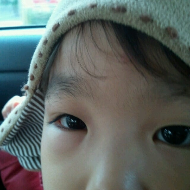 子どものまぶたの腫れは病気のサイン？その原因や対処法Vol.1子どもの病気ピカラダ飯塚病院