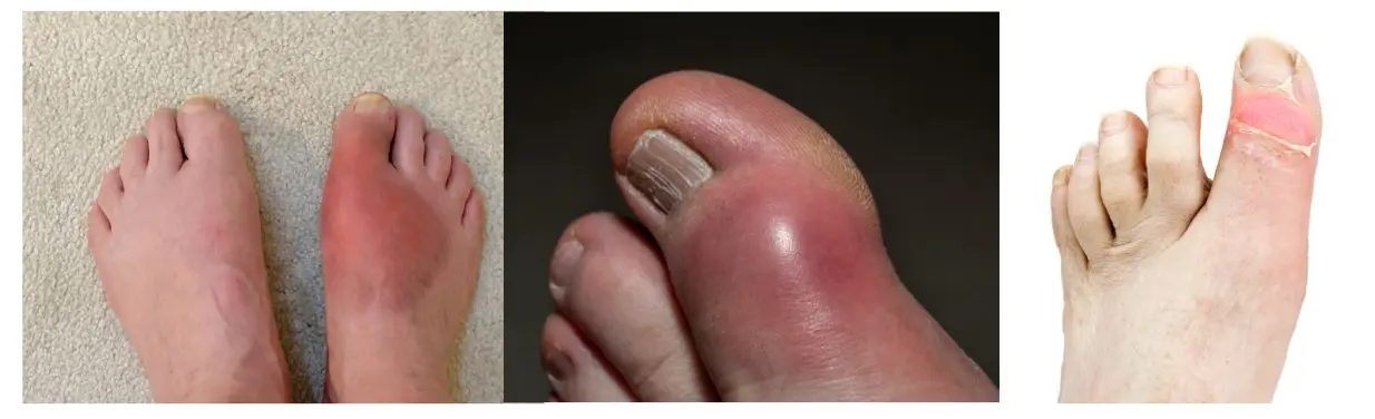 繰り返す「痛風」発作腫れ、熱感を伴う激痛 新治療で長引く痛み改善⑭ fun okinawa～ほーむぷらざ～