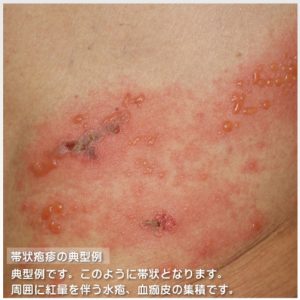 糖尿病の場合、皮膚にどのような症状が現れますか？ 糖尿病