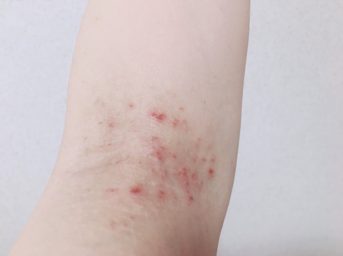 子どもが汗疹 あせも になったときはどうすればいい？治し方や湿疹との違い・対策法について -千葉内科在宅・美容皮膚科クリニック 千葉市稲毛区の内科外来