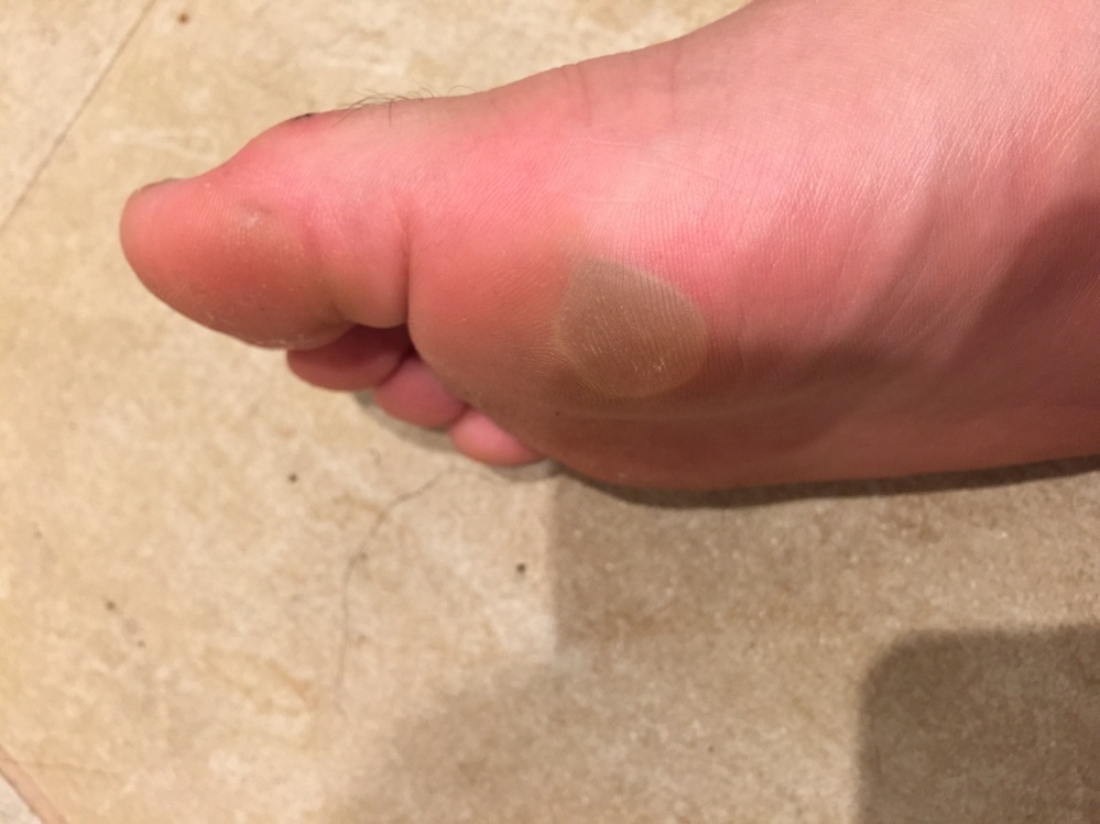 靴擦れはどうやって治療する？水ぶくれが破れたら？早くなおすポイント病気スコープ