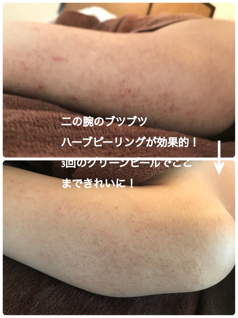 二の腕ぶつぶつ 毛孔性苔癬の効果的治療 祝 卒業- シンシア総院長ブログ～Sincerely Yours 銀座の美容外科・美容皮膚科