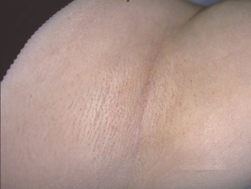 レーザー脱毛 ワキ の症例写真症例写真集共立美容外科宇都宮院 栃木県宇都宮市の美容外科・美容皮膚科 美容整形