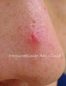 鼻のニキビの原因と対策 - ニキビ研究室 医師監修ニキビ治療はニキビ専門皮膚科のオラクル美容皮膚科 ニキビ外来