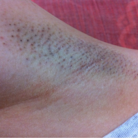 脇のブツブツが気になる若い女性の写真・画像素材-Snapmart スナップマート