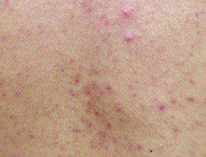 背中の赤いぶつぶつが治らない、背中のニキビが治らない時はマラセチア毛包炎かも。 背中ニキビは通常のニキビ治療を行なっても治らないわけではありませんが、 背中のニキビを通常のニキビ薬のみで治すと４週間から６週間程度かかる場合が多いです。しかしマラセチアを