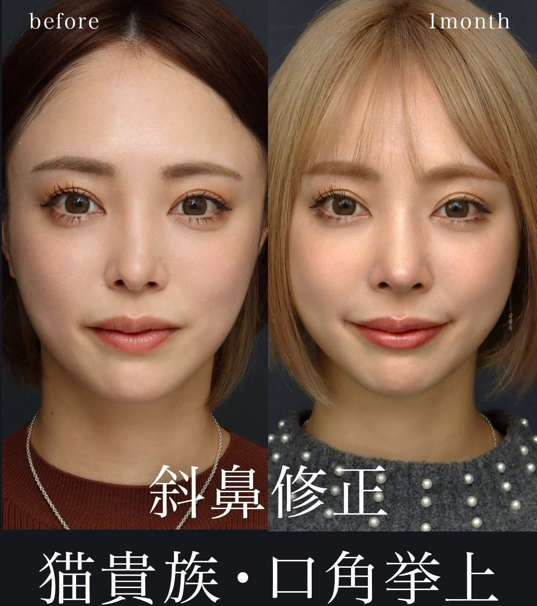 鼻の重心を下げ、鼻全体が前に移動したことで立体感のある小顔に - 福岡 東京渋谷代官山美容形成外科 診療施術 ビスポーククリニック