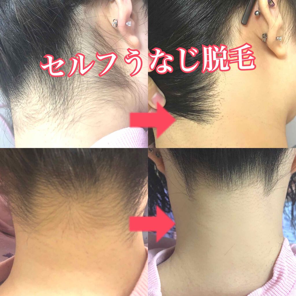 襟足＆うなじに「ニキビ」 どうして？ 原因を皮膚科医に聞いてみたオトナンサ