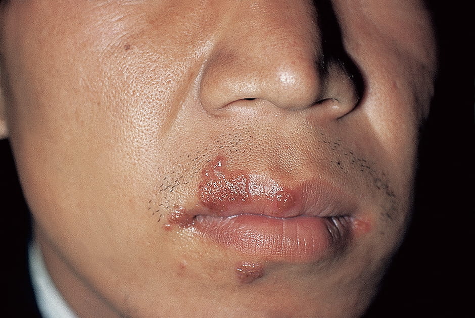 口唇ヘルペスのケアの仕方大正健康ナビ大正製薬