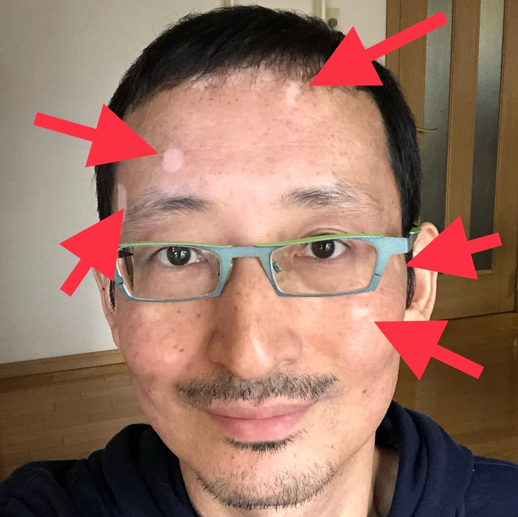 尋常性白斑の意外な死亡リスクの低さ、海外研究から明らかにヒフコNEWS