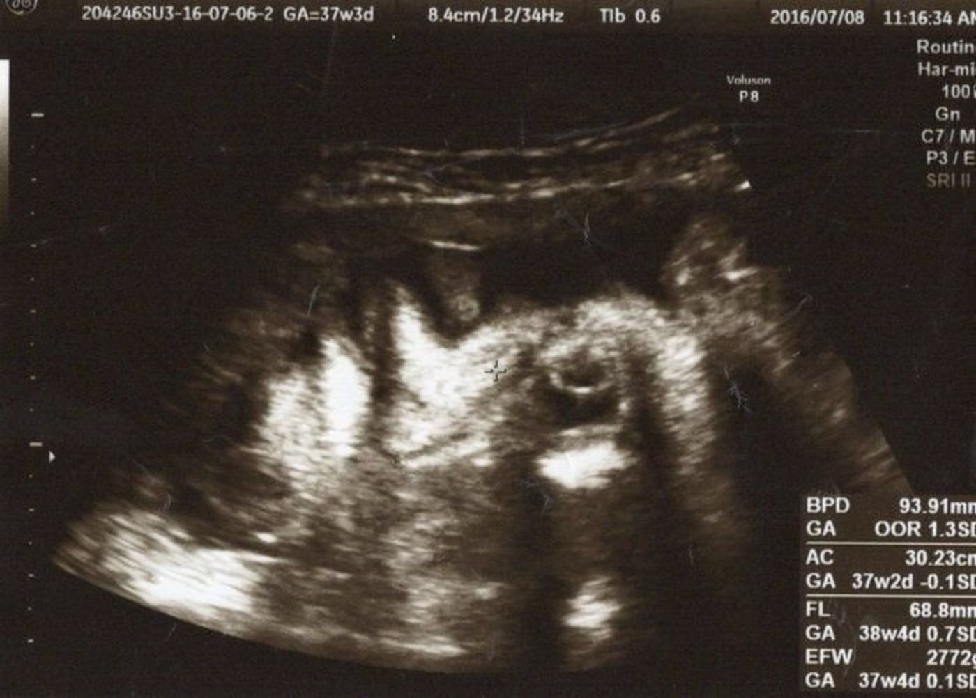 医師監修 エコー写真ってどう見るの？３D、４Dエコーって何？ゼクシィBaby